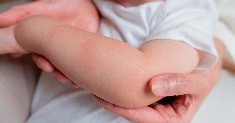 picaduras-de-mosquitos-en-bebes-2